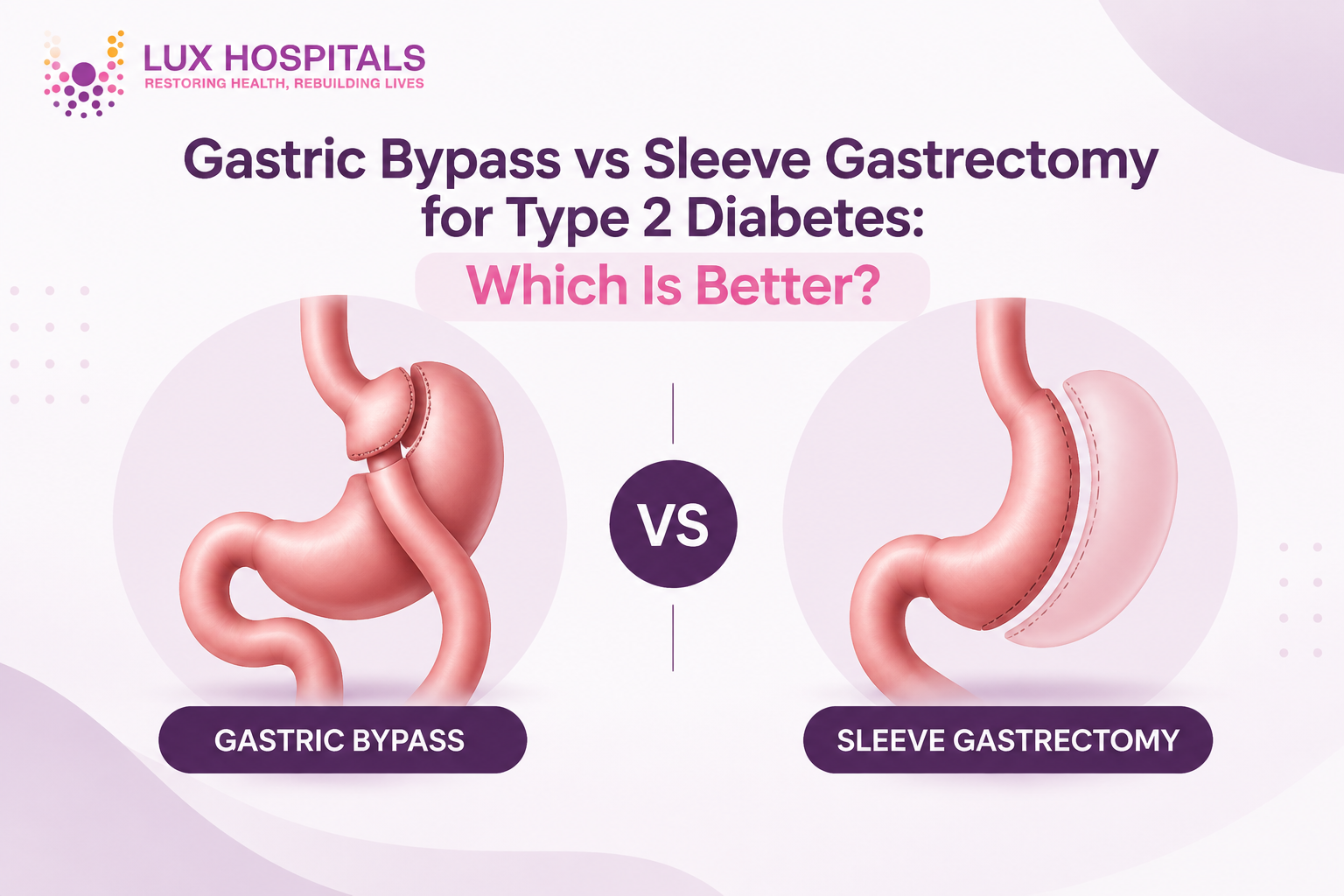Gastric Bypass vs Sleeve Gastrectomy for Type 2 Diabetes: Which Is Better?