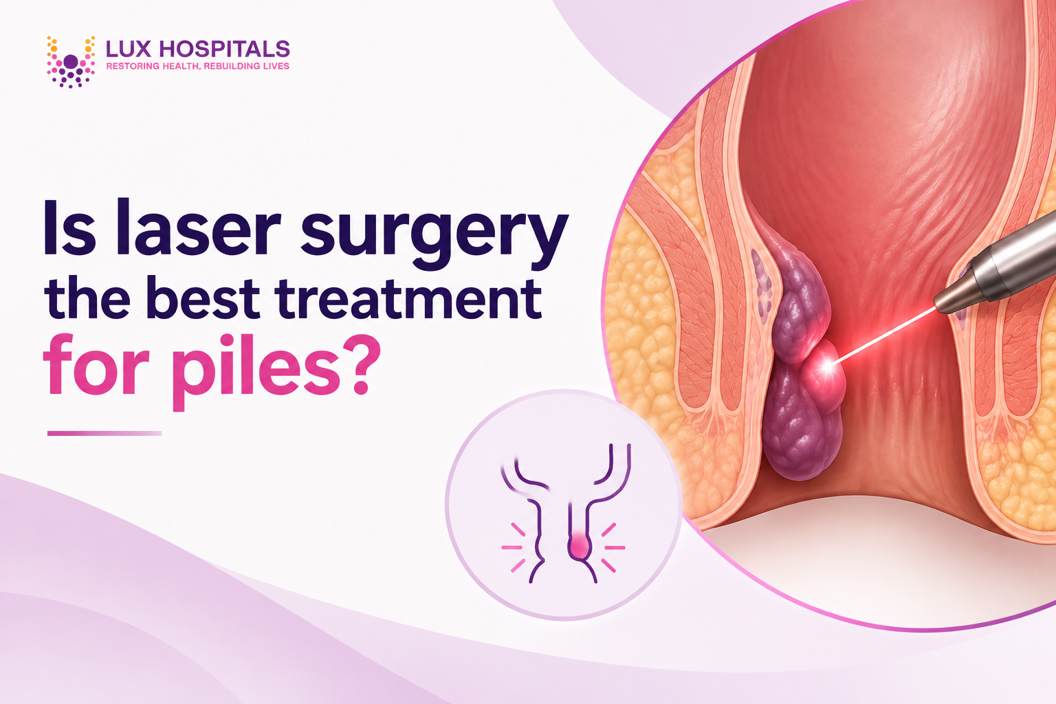 Is Laser Surgery the Best Treatment for Piles?