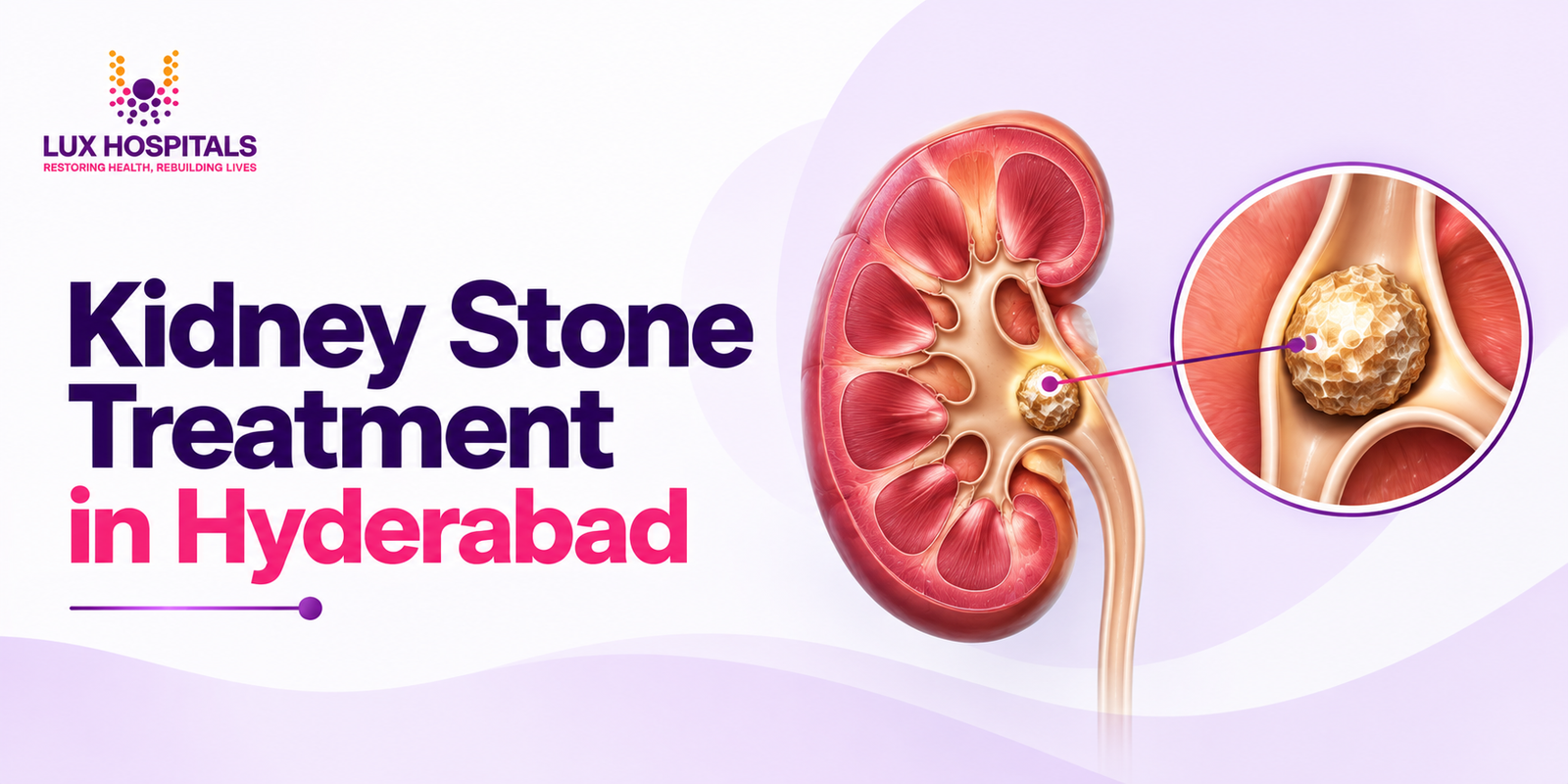 Kidney Stone Treatment in Hyderabad: What Procedure Is Right for You?