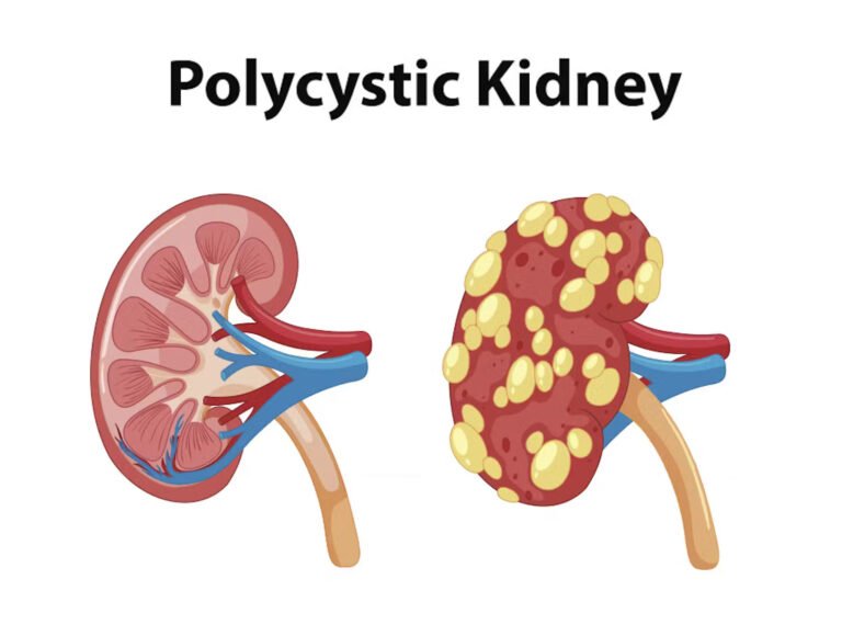 Polycystic Kidney Disease: Innovative Solutions at Lux - Best Hospital ...