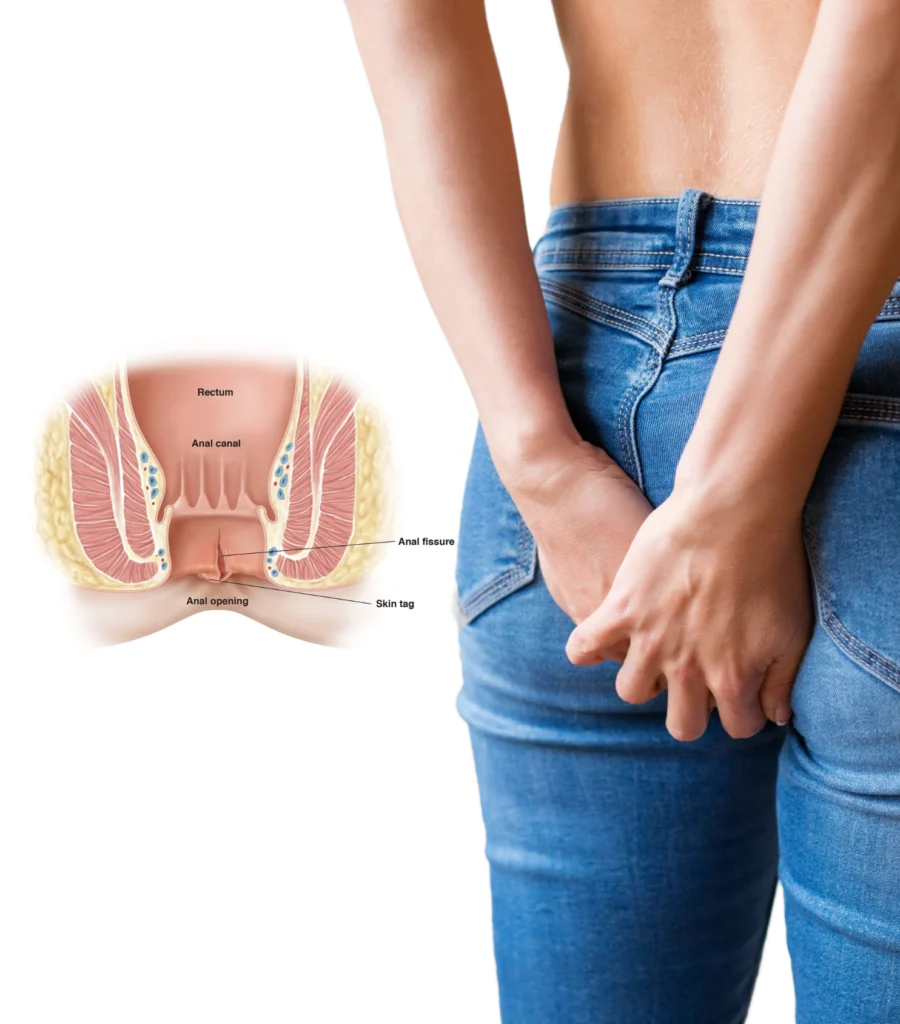 Best fissure treatment in hyderabad