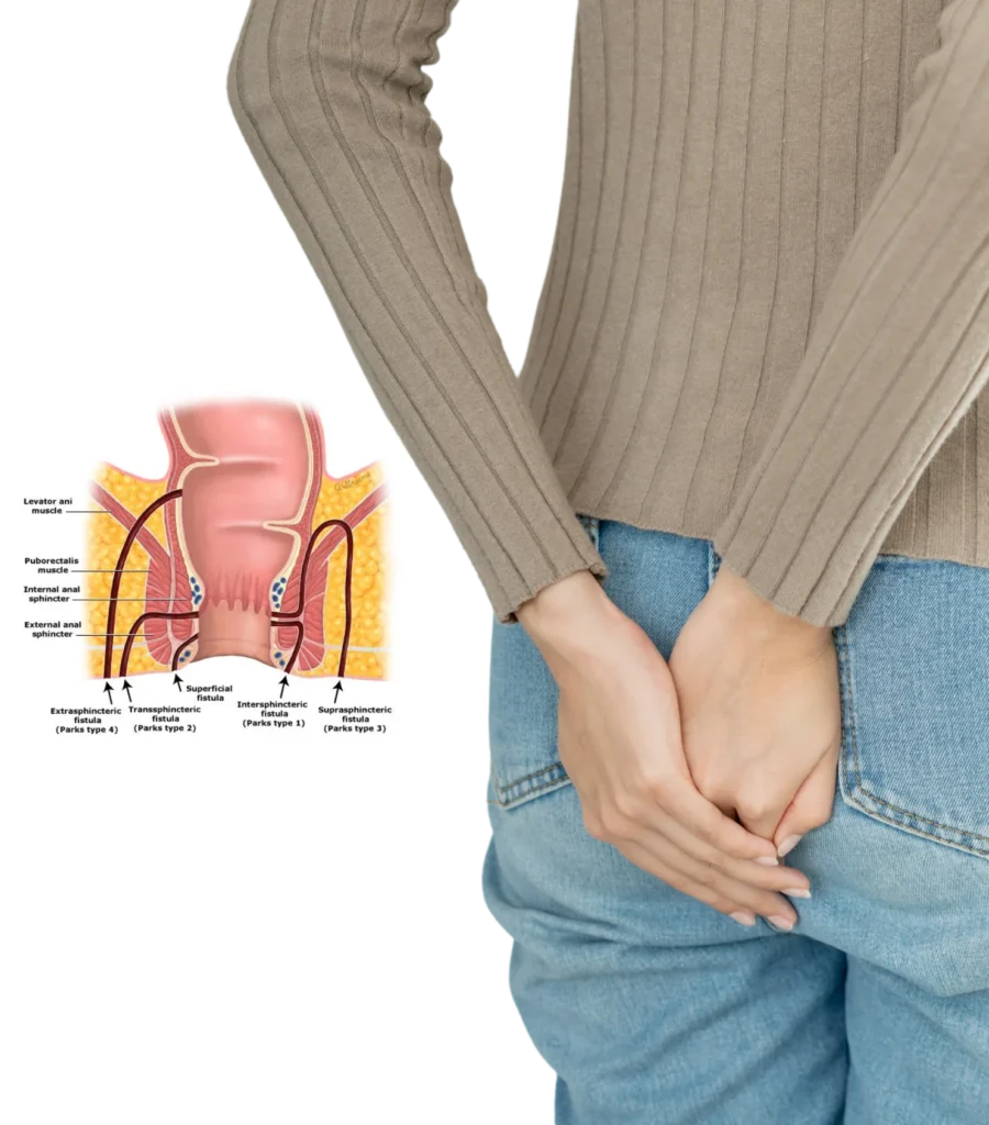 Best fistula treatment in hyderabad