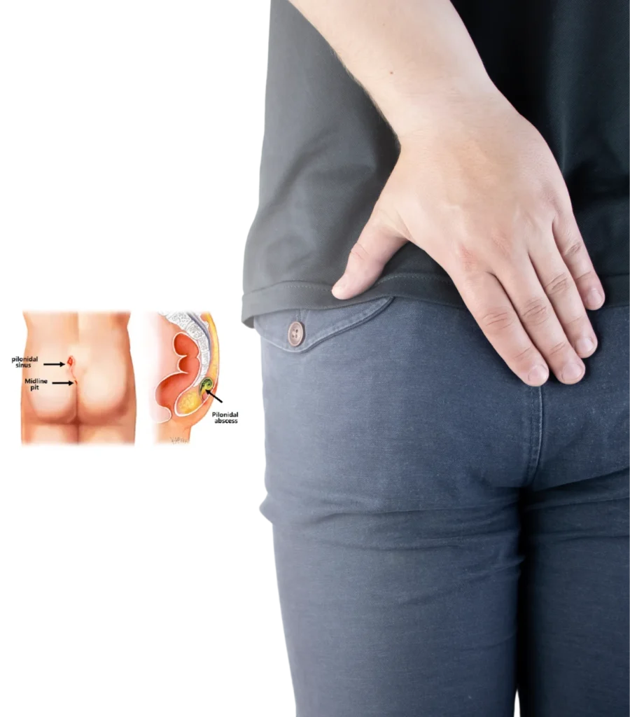 Pilonidal Sinus Treatment in Hyderabad