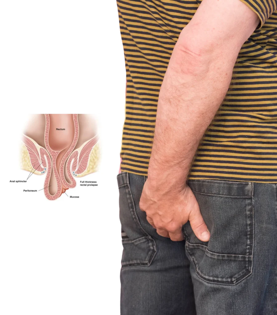 Rectal Prolapse Treatment in Hyderabad