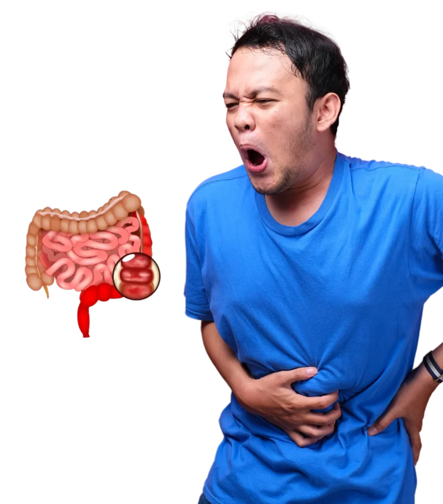 Best Ulcerative Colitis Treatment in Hyderabad
