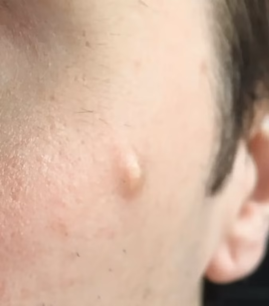 A specialist at Lux Hospitals performing advanced cyst treatment in Hyderabad for painless removal and faster recovery.