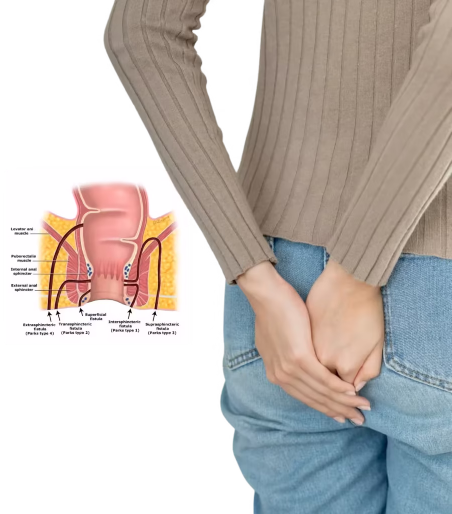 Fistula treatment in Hyderabad at Lux Hospitals